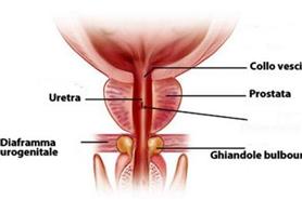 PROSTATITE ABATTERICA