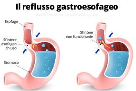 Reflusso Gastro Esofageo